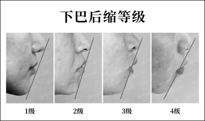 體育博彩：很難說這個bug和頭禿哪個更致命